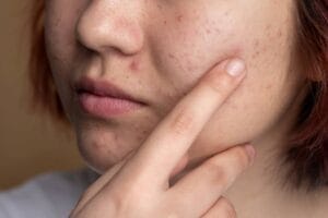 نکاتی برای کنترل آکنه