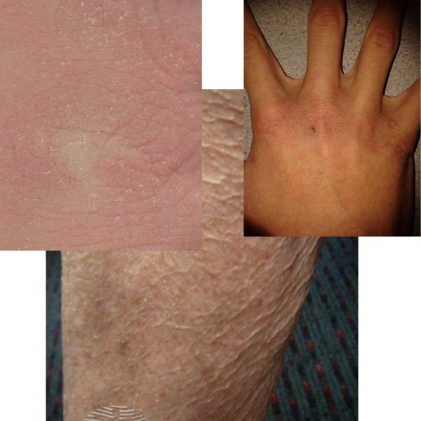 پوست خشک Xerosis Cutis