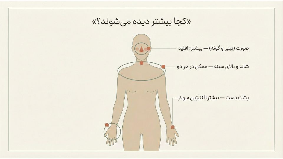 تصویر آموزشی محل‌های شایع کک و مک اِفِلید روی صورت و لک آفتابی لنتیژین سولار روی پشت دست 