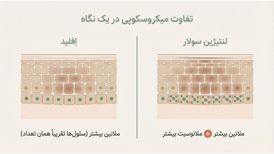 دیاگرام تفاوت میکروسکوپی انواع کک و مک: افزایش ملانین در اِفِلید و افزایش ملانین همراه با ملانوسیت در لنتیژین سولار 
