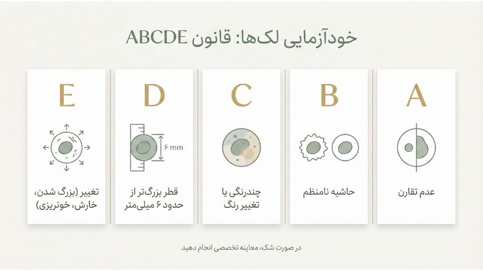اینفوگرافیک قانون ABCDE برای خودآزمایی خال‌ها و پیشگیری از سرطان پوست همراه با محافظت از آفتاب 
