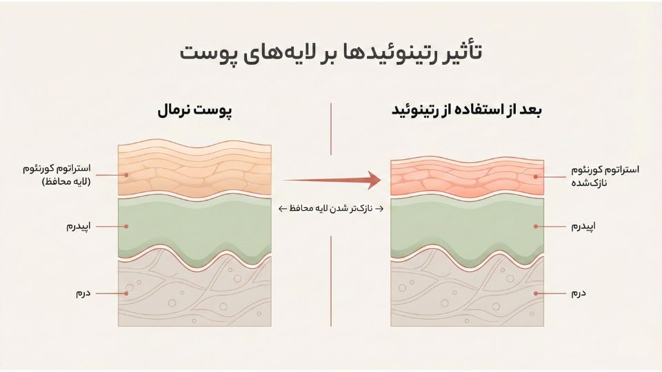 نمودار آناتومیک مقایسه لایه‌های پوست قبل و بعد از استفاده از رتینوئید و نازک شدن استراتوم کورنئوم 