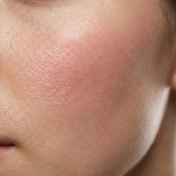 قرمزی و برافروختگی صورت