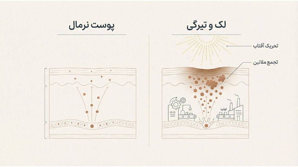 مقایسه پوست نرمال و پوست دچار لک: تاثیر آفتاب بر فعالیت بیش از حد ملانوسیت‌ها و تجمع ملانین. 