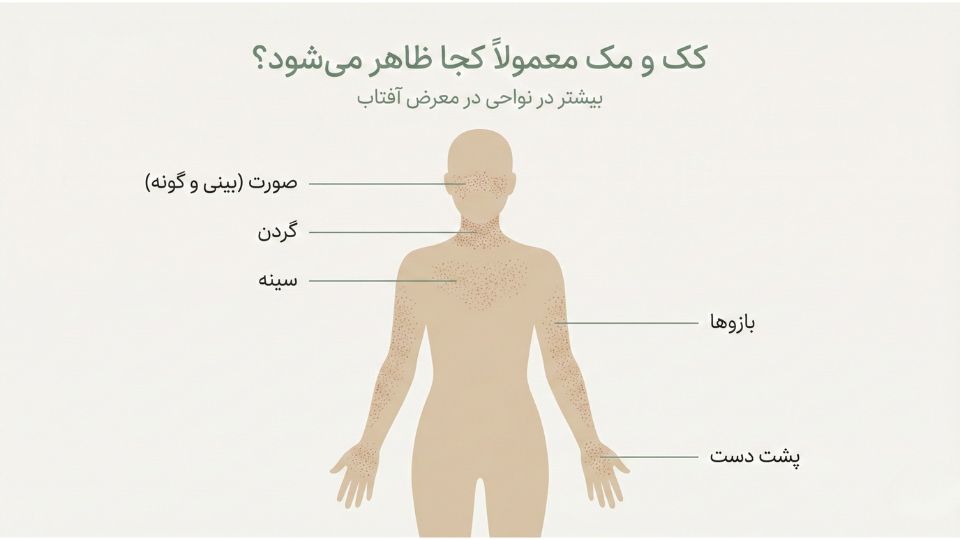 «اینفوگرافیک محل‌های شایع کک و مک: صورت، گردن، سینه، بازو و پشت دست در نواحی در معرض آفتاب»