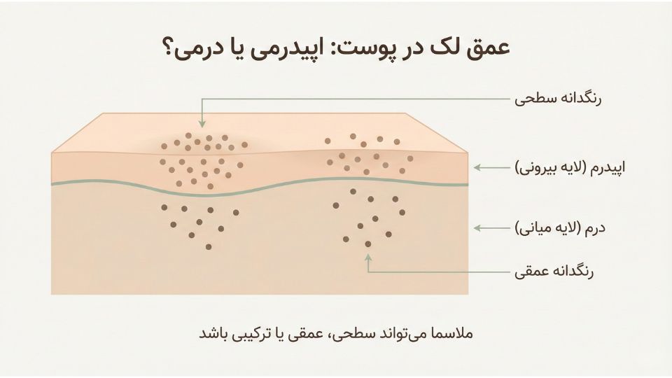 دیاگرام لایه‌های پوست نشان‌دهنده تفاوت رنگدانه سطحی (اپیدرمی) و عمقی (درمی) در ملاسما 
