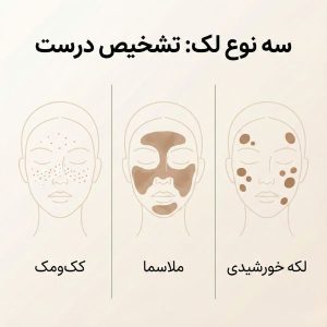 اینفوگرافیک مقایسه سه نوع لک پوست: کک‌ومک، ملاسما و لکه خورشیدی با نمایش الگوی توزیع هر کدام