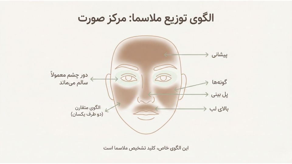 دیاگرام الگوی توزیع ملاسما در مرکز صورت شامل پیشانی، گونه‌ها و بالای لب با حفظ ناحیه دور چشم 
