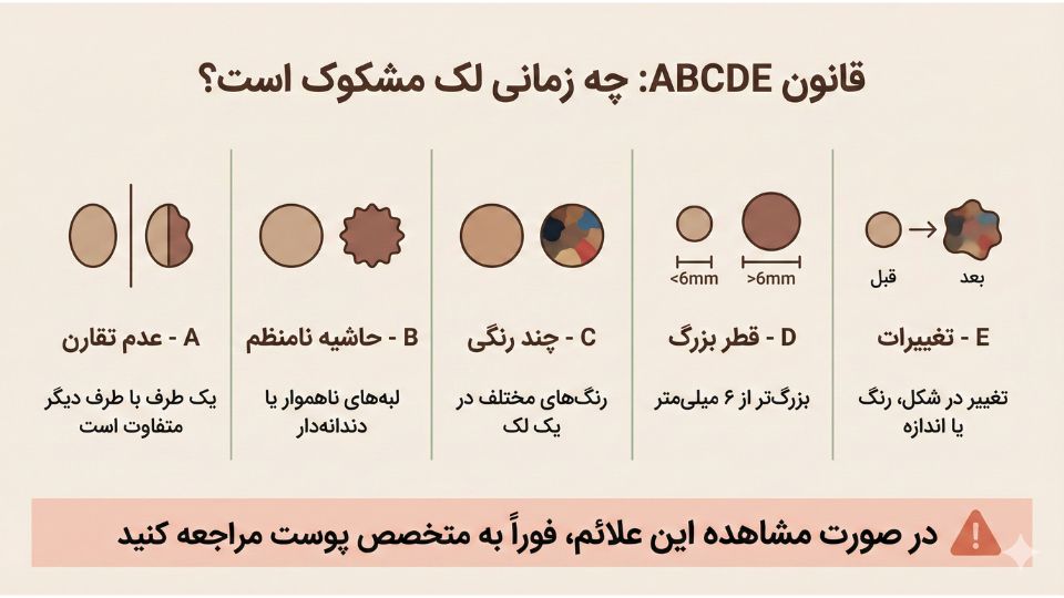 اینفوگرافیک قانون ABCDE برای شناسایی لک‌های مشکوک: عدم تقارن، حاشیه نامنظم، چند رنگی، قطر بزرگ و تغییرات 