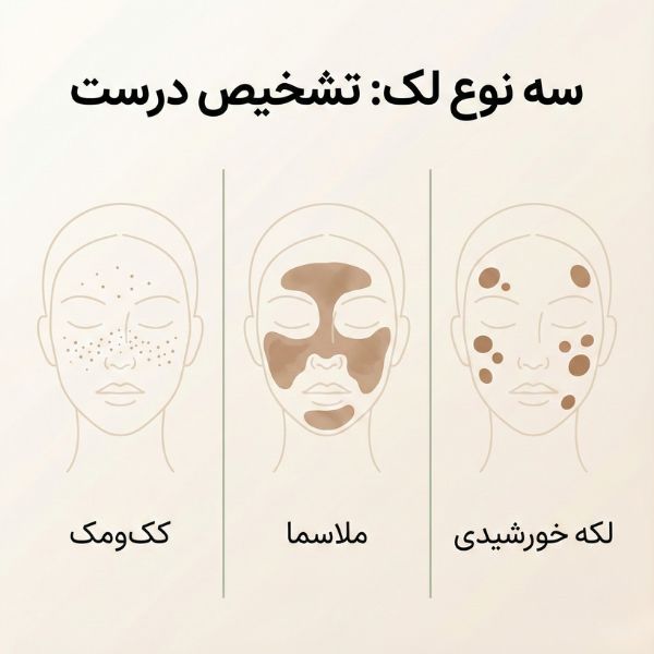 اینفوگرافیک مقایسه سه نوع لک پوست: کک‌ومک، ملاسما و لکه خورشیدی با نمایش الگوی توزیع هر کدام
