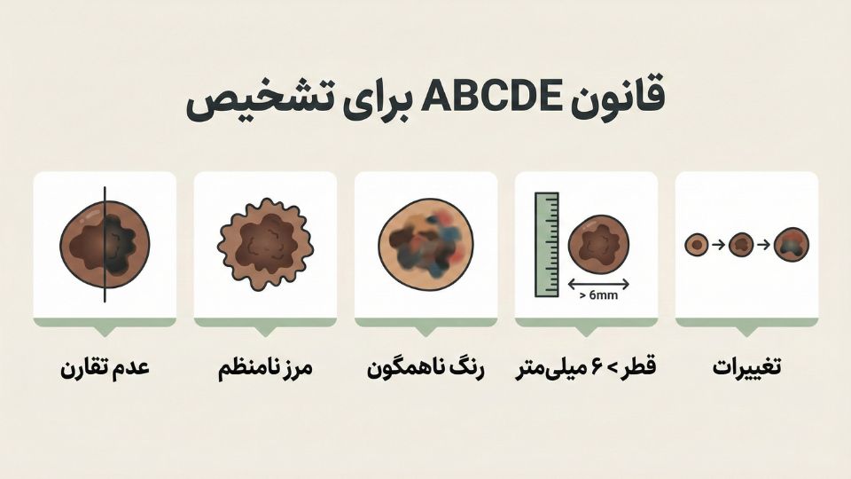 اینفوگرافیک قانون ای‌بی‌سی‌دی‌ئی برای تشخیص علائم سرطان پوست شامل عدم تقارن، مرز، رنگ، قطر و تغییرات 