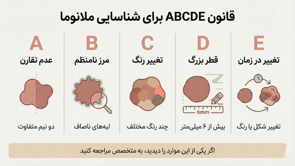 اینفوگرافیک قانون ABCDE برای تشخیص علائم ملانوما و خالهای مشکوک