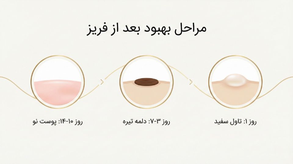 تصویر مراحل بهبود پوست بعد از کرایوتراپی: تاول، دلمه و پوست نو در طی دو هفته 