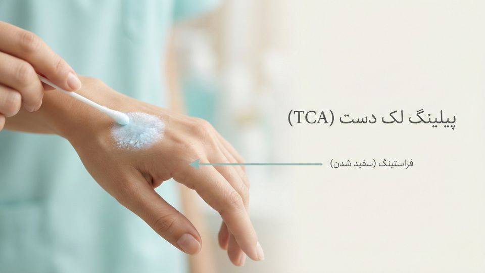 تصویر درمان لک دست با پیلینگ TCA و نمایش حالت فراستینگ یا سفید شدن روی لک 