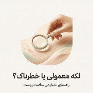 تصویر مینیمال و لوکس دست با ذرهبین برای بررسی لکه پوست با عنوان لکه معمولی یا خطرناک