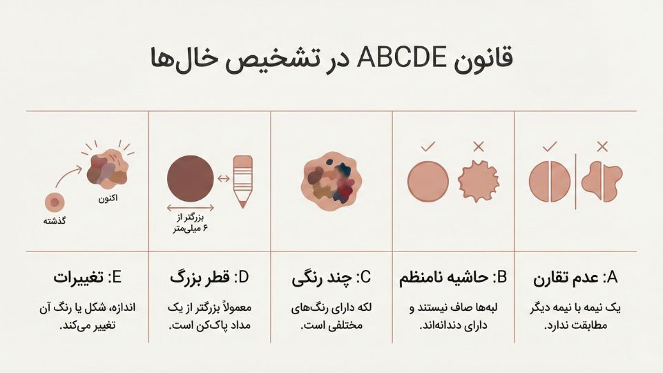 اینفوگرافیک قانون ABCDE برای تشخیص سرطان پوست شامل عدم تقارن حاشیه نامنظم چندرنگی و تغییرات