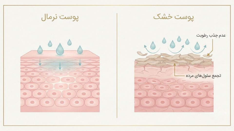 مقایسه تصویری پوست نرمال و پوست خشک با تجمع سلول‌های مرده که مانع جذب رطوبت می‌شوند 
