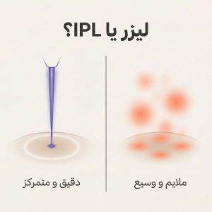 تصویر مقایسه مفهومی لیزر و IPL برای درمان لک صورت؛ لیزر متمرکز در برابر نور پراکنده IPL