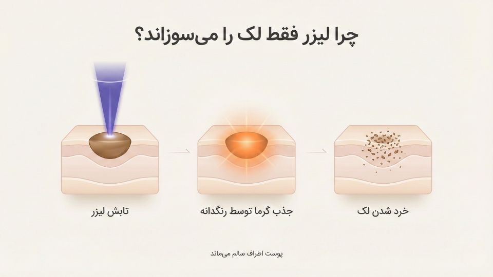 اینفوگرافیک مراحل عملکرد لیزر روی لک پوست: تابش، جذب گرما توسط ملانین و خرد شدن لک بدون آسیب به پوست سالم