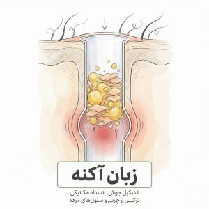 تصویر آموزشی مقطع پوست نشان‌دهنده مکانیسم انسداد منافذ با چربی سبوم و سلول‌های مرده به عنوان علت ایجاد آکنه و جوش صورت