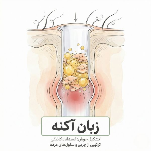 تصویر آموزشی مقطع پوست نشان‌دهنده مکانیسم انسداد منافذ با چربی سبوم و سلول‌های مرده به عنوان علت ایجاد آکنه و جوش صورت