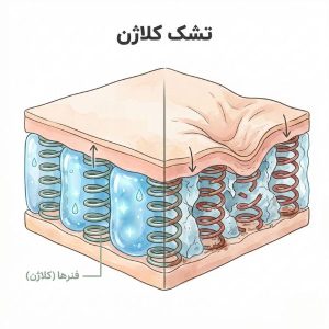 تصویر آموزشی برش عرضی پوست به‌صورت تشک فنری که فنرهای کلاژن سالم و آسیب‌دیده را مقایسه می‌کند - پیری پوست - هانالایف