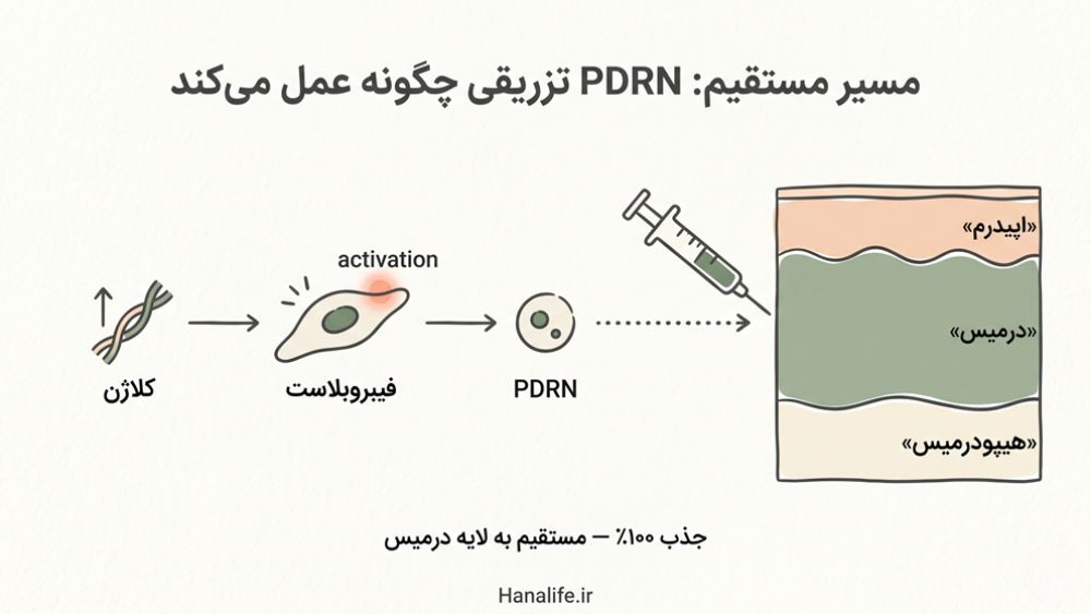 دیاگرام آموزشی مسیر PDRN تزریقی از سرنگ به لایه درمیس پوست و فعال‌سازی سلول‌های فیبروبلاست