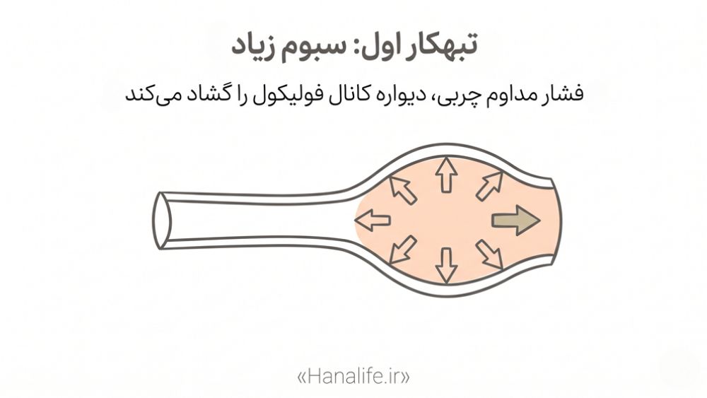 تصویر مفهومی اتساع کانال فولیکول در اثر فشار سبوم — سبوم و منافذ پوست