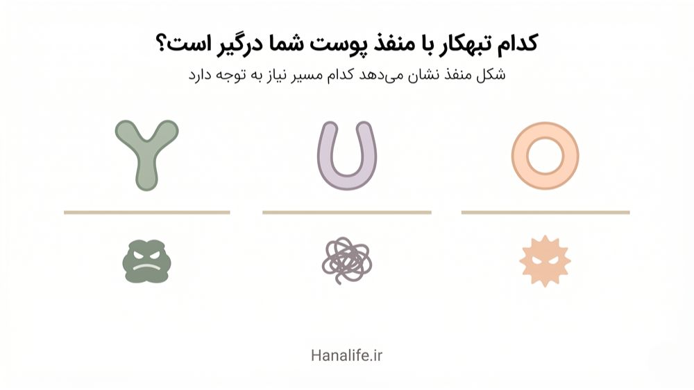 اینفوگرافیک ارتباط انواع منافذ O، U و Y با سه علت اصلی بزرگ شدن منافذ پوست