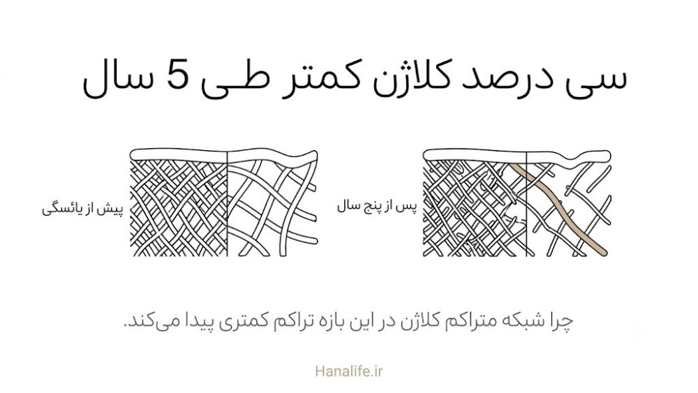 مقطع پوست با شبکه متراکم کلاژن در سمت راست و شبکه کمتراکم در سمت چپ پس از یائسگی — هانالایف