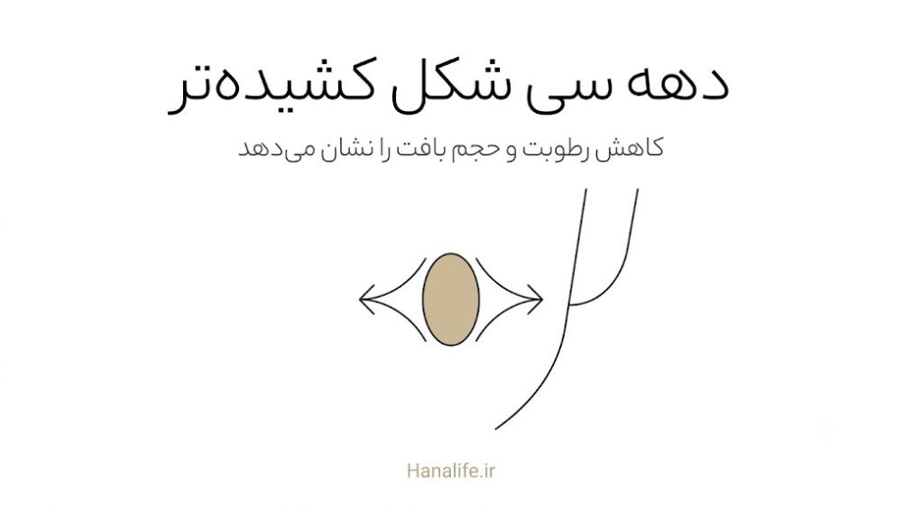 منافذ U شکل و کاهش الاستیسیته در دهه سی سالگی — هانالایف