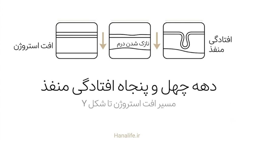 افتادگی منافذ Y شکل ناشی از کاهش استروژن در سن بالا — هانالایف