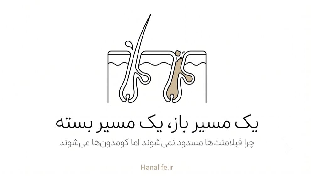 مقطع فولیکول نشان‌دهنده تفاوت فیلامنت سباسه و جوش سرسیاه — هانالایف