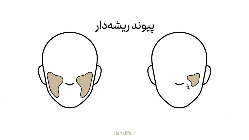 مقایسه الگوی متقارن ملاسما ایرانی با لک پس‌التهابی روی صورت — هانالایف