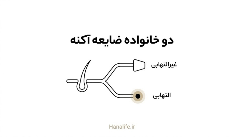 انشعاب فولیکول به مسیر غیرالتهابی و التهابی — انواع جوش — هانالایف