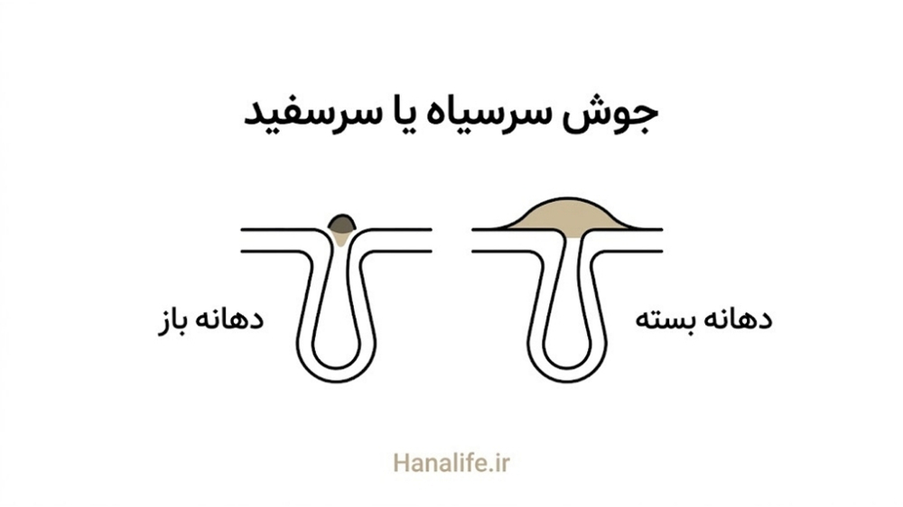 مقایسه مقطع کومدون باز و کومدون بسته — جوش سرسیاه و جوش سرسفید — هانالایف