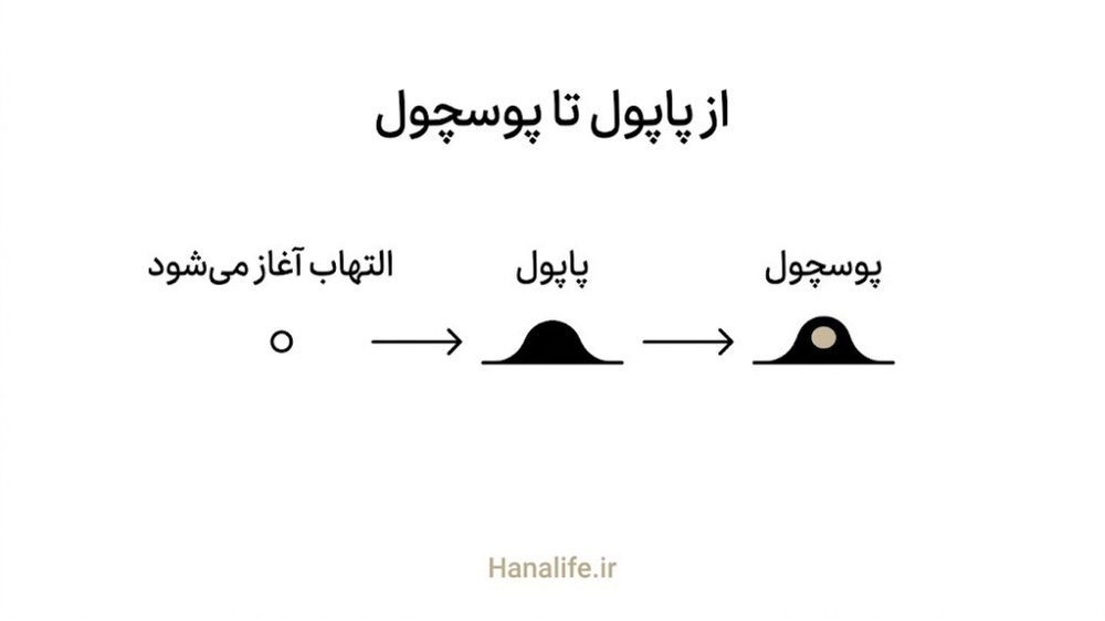 توالی تصویری پیشرفت پاپول به پوسچول — پاپول و پوسچول — هانالایف