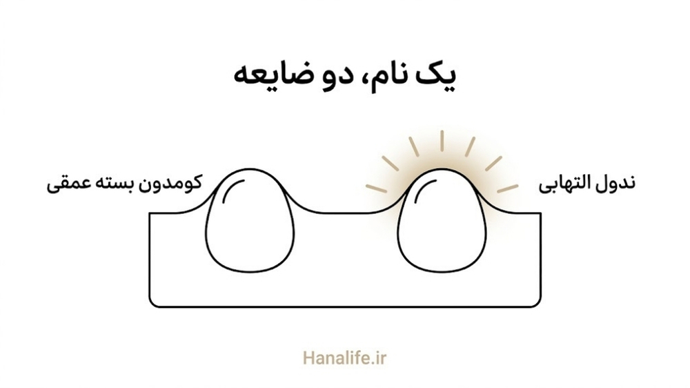 مقطع پوست با کومدون بسته عمقی در کنار ندول التهابی — جوش زیرپوستی — هانالایف