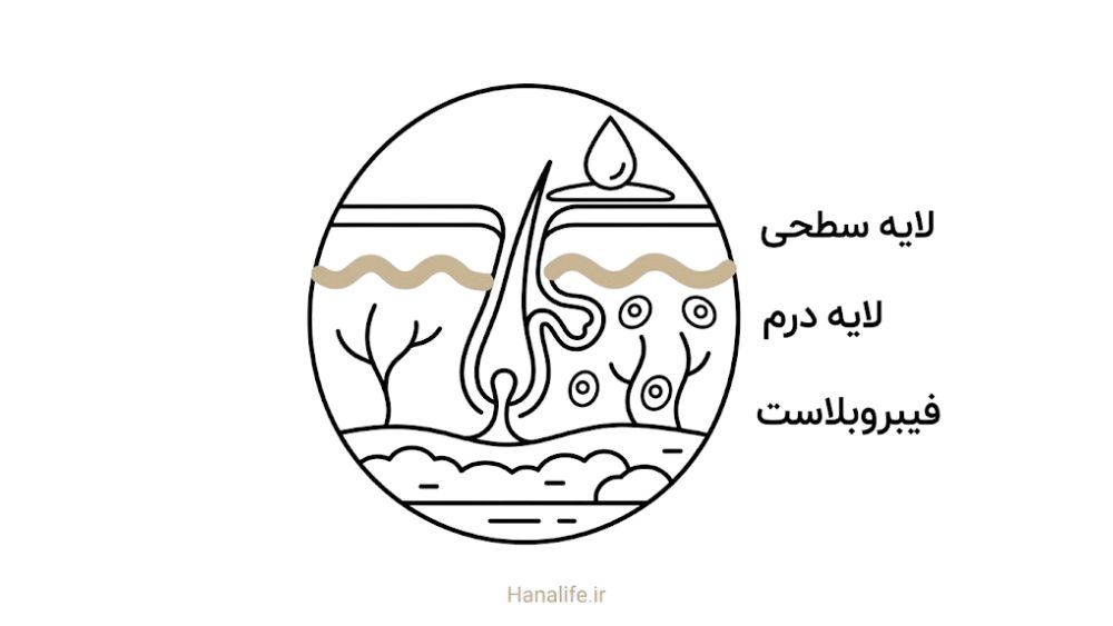 مقطع پوست با نمایش محدودیت نفوذ سرم موضعی تا لایه درم — منافذ باز پوست — هانالایف