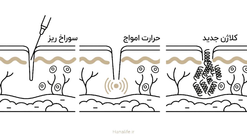مراحل اثر RF میکرونیدلینگ بر تولید کلاژن در عمق پوست — RF میکرونیدلینگ منافذ — هانالایف