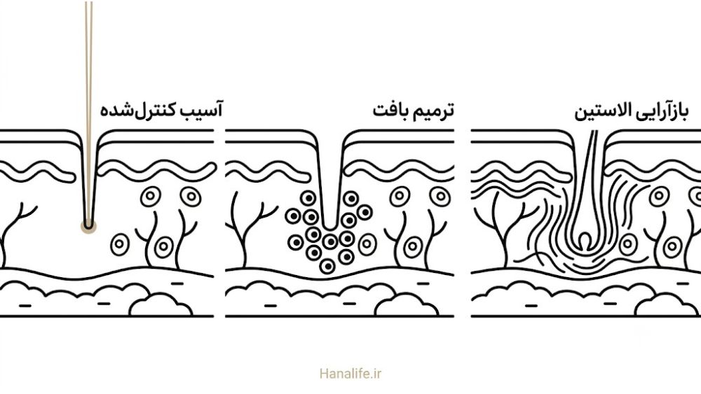  مراحل بازسازی کلاژن پس از لیزر فرکشنال در اطراف منفذ پوست — لیزر منافذ پوست — هانالایف