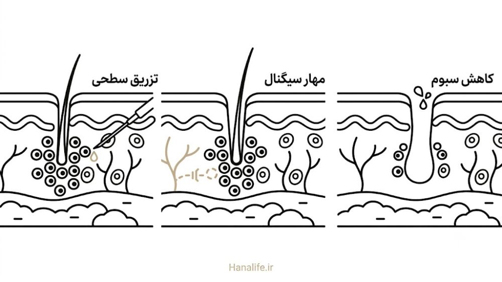 مکانیزم میکروبوتاکس در کاهش فعالیت غده سباسه اطراف منفذ — میکروبوتاکس منافذ — هانالایف