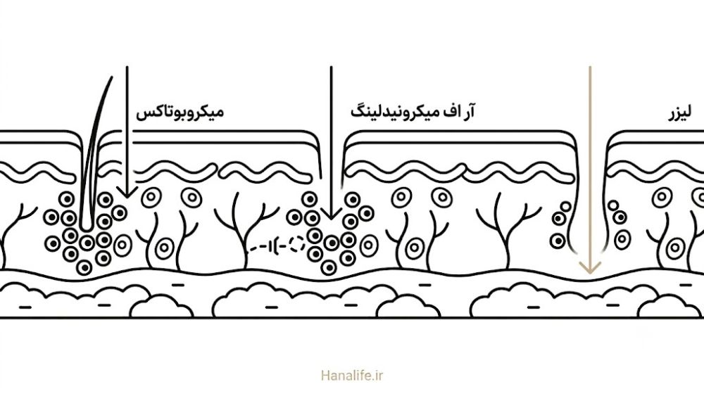 مقایسه عمق نفوذ میکروبوتاکس، لیزر و آر اف میکرونیدلینگ در پوست — درمان کلینیکال منافذ — هانالایف