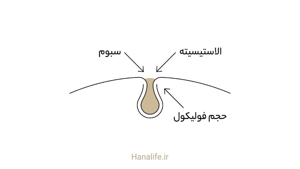برشنمای خطی منفذ پوست با سه علت اصلی بزرگی منافذ، سبوم و الاستیسیته و فولیکول