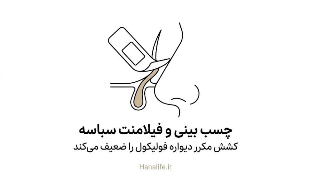 چسب بینی در حال کشیدن فیلامنت سباسه از سطح بینی و کشش دیواره فولیکول — چسب بینی مضر — هانالایف