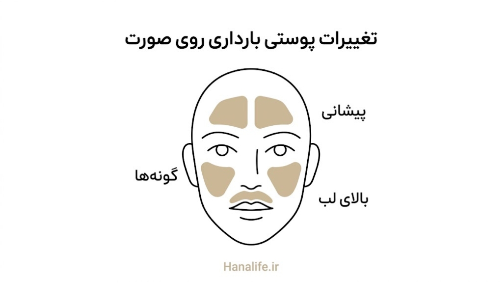 نقشه نواحی ملاسما روی صورت در تغییرات پوستی بارداری — هانالایف