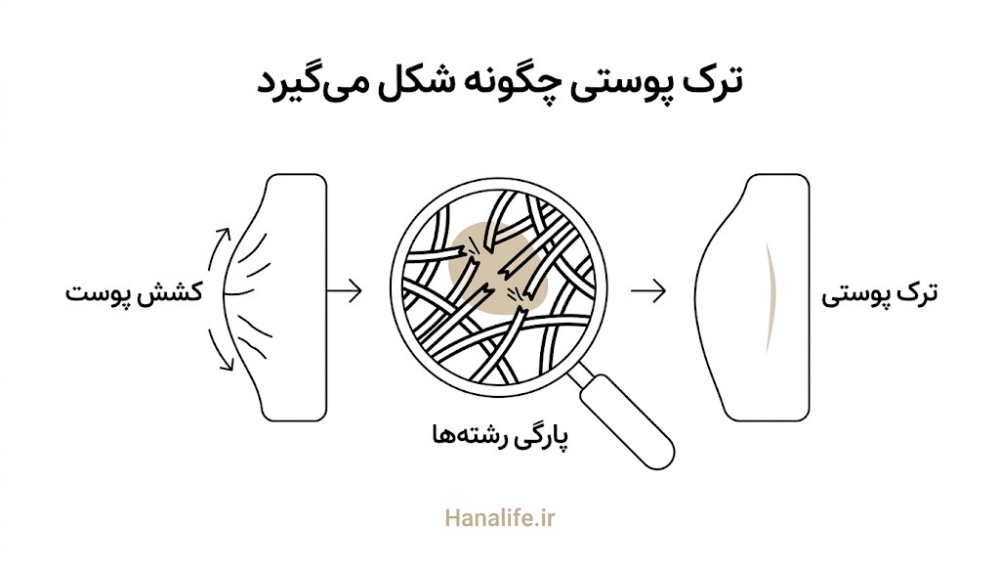  مراحل شکل‌گیری ترک بارداری زیر کشش پوست — هانالایف