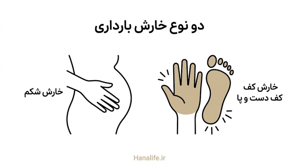 مقایسه خارش معمول شکم و خارش هشداردهنده کف دست و پا در بارداری — هانالایف