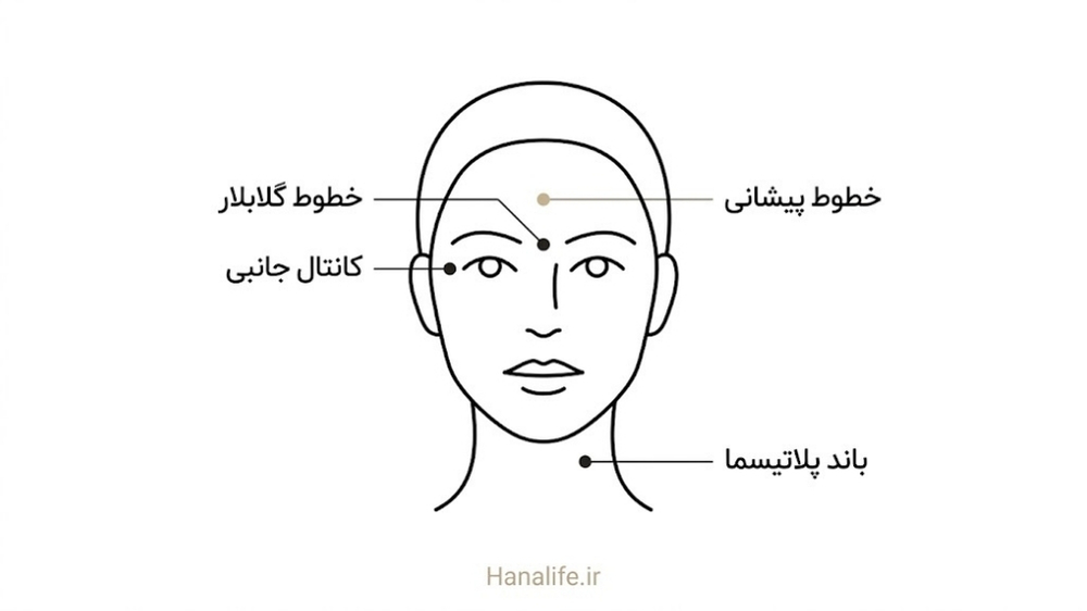 نقشه چهار ناحیه صورت و گردن با تایید رسمی برای بوتاکس — بوتاکس برای چه خطوطی — هانالایف