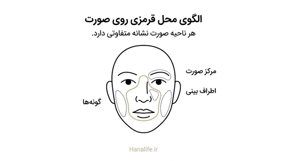 نقشه سه ناحیه صورت شامل مرکز صورت اطراف بینی و گونهها برای تشخیص محل قرمزی پوست صورت